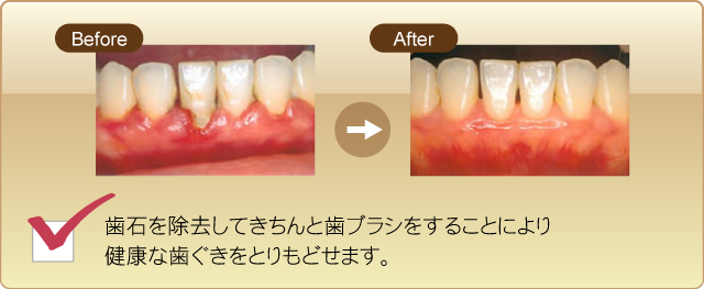 歯石を除去してきちんと歯ブラシをすることにより健康な歯茎をとりもどせます