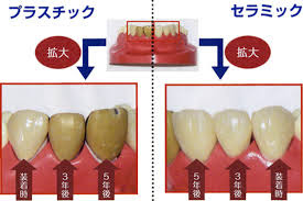 銀歯は歯茎を黒くなる可能性がある