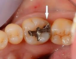 銀盤の下で虫歯になりやすい