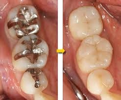 銀歯を自費治療のプラスチックで白くする方法